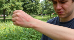 Rayden Vollrath Pokeweed Allergic Reaction